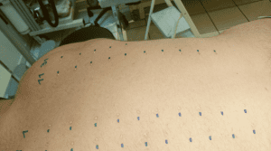 allergy skin test on the back