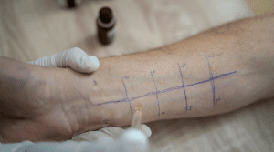 allergy skin test on arm