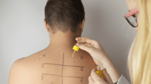 allergy skin test on a patient's back